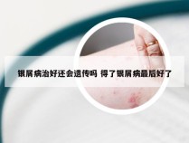 银屑病治好还会遗传吗 得了银屑病最后好了