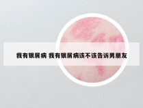 我有银屑病 我有银屑病该不该告诉男朋友