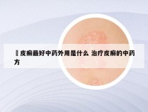 牜皮癣最好中药外用是什么 治疗皮癣的中药方
