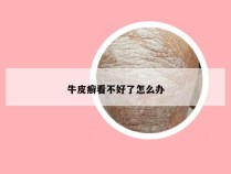 牛皮癣看不好了怎么办