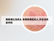 银屑病让当兵么 有银屑病史的人,符合当兵条件吗