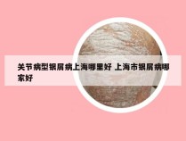 关节病型银屑病上海哪里好 上海市银屑病哪家好