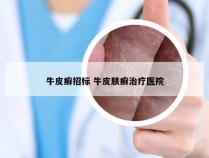 牛皮癣招标 牛皮肤癣治疗医院