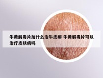 牛黄解毒片加什么治牛皮癣 牛黄解毒片可以治疗皮肤病吗