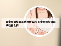 儿童点滴型银屑病擦什么药 儿童点滴型银屑病吃什么药