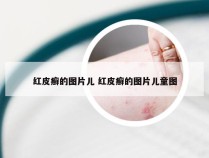 红皮癣的图片儿 红皮癣的图片儿童图