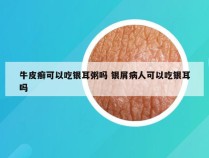牛皮癣可以吃银耳粥吗 银屑病人可以吃银耳吗