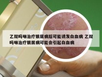 乙双吗啉治疗银屑病后可能诱发白血病 乙双吗啉治疗银屑病可能会引起白血病