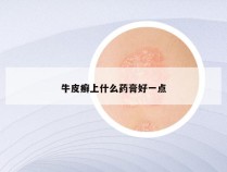 牛皮癣上什么药膏好一点