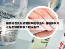 扁桃体发炎后的银屑病能根治吗 扁桃体发炎引起的银屑病多长时间能好