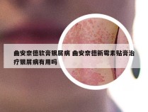 曲安奈德软膏银屑病 曲安奈德新霉素贴膏治疗银屑病有用吗