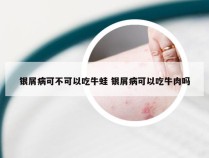 银屑病可不可以吃牛蛙 银屑病可以吃牛肉吗