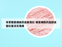 寻常银屑病抹药皮肤发红 银屑病擦药后脱皮变红变淡又发痒