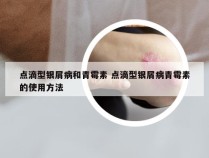 点滴型银屑病和青霉素 点滴型银屑病青霉素的使用方法