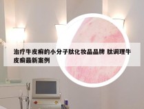 治疗牛皮癣的小分子肽化妆品品牌 肽调理牛皮癣最新案例