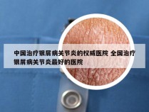 中国治疗银屑病关节炎的权威医院 全国治疗银屑病关节炎最好的医院