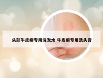 头部牛皮癣专用洗发水 牛皮癣专用洗头膏