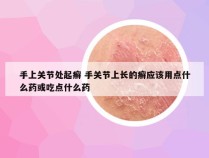 手上关节处起癣 手关节上长的癣应该用点什么药或吃点什么药