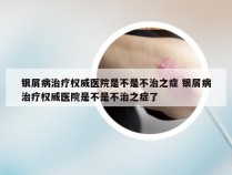 银屑病治疗权威医院是不是不治之症 银屑病治疗权威医院是不是不治之症了