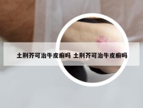 土荆芥可治牛皮癣吗 土荆芥可治牛皮癣吗