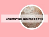 山东青岛看牛皮癣 青岛治银屑病医院排名