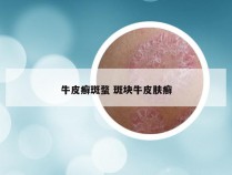牛皮癣斑蝥 斑块牛皮肤癣