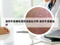血热牛皮癣吃清热凉血丸行吗 血热牛皮廨治疗