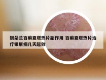 银朵兰百癣夏塔热片副作用 百癣夏塔热片治疗银屑病几天起效