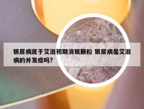 银屑病属于艾滋初期消银颗粒 银屑病是艾滋病的并发症吗?