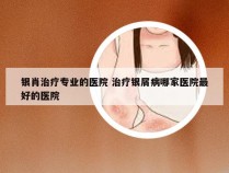 银肖治疗专业的医院 治疗银屑病哪家医院最好的医院