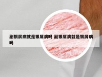 副银屑病就是银屑病吗 副银屑病就是银屑病吗