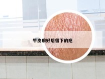 牛皮癣好后留下的疤