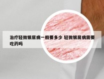 治疗轻微银屑病一般要多少 轻微银屑病需要吃药吗