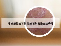 牛皮癣铁皮石斛 铁皮石斛能治皮肤病吗