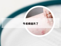 牛皮癣连片了