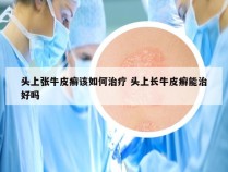 头上张牛皮癣该如何治疗 头上长牛皮癣能治好吗