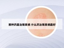 那种药最治银屑病 什么药冶银屑病最好