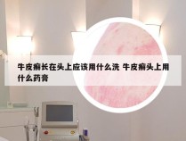牛皮癣长在头上应该用什么洗 牛皮癣头上用什么药膏