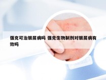 强克可治银屑病吗 强克生物制剂对银屑病有效吗