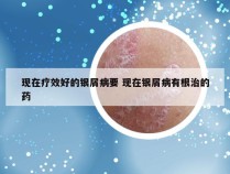 现在疗效好的银屑病要 现在银屑病有根治的药