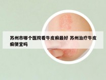 苏州市哪个医院看牛皮癣最好 苏州治疗牛皮癣便宜吗