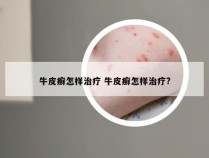牛皮癣怎样治疗 牛皮癣怎样治疗?