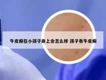 牛皮癣在小孩子身上会怎么样 孩子有牛皮癣