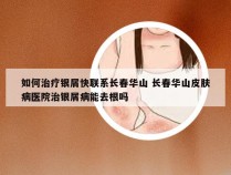 如何治疗银屑快联系长春华山 长春华山皮肤病医院治银屑病能去根吗