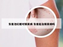 生姜泡红糖对银屑病 生姜能治银屑病吗