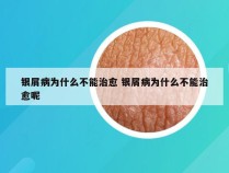 银屑病为什么不能治愈 银屑病为什么不能治愈呢