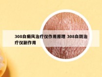 308白癜风治疗仪作用原理 308白斑治疗仪副作用