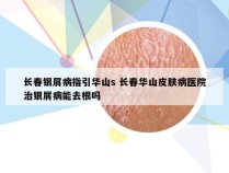 长春银屑病指引华山s 长春华山皮肤病医院治银屑病能去根吗