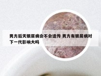 男方后天银屑病会不会遗传 男方有银屑病对下一代影响大吗