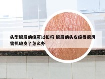 头型银屑病痒可以扣吗 银屑病头皮痒得很厉害抓破皮了怎么办